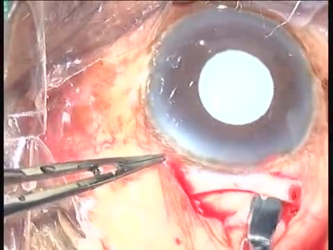Hyper Mature Cataract SICS