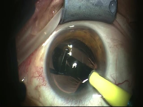Novel Small Aperture Intraocular Implant