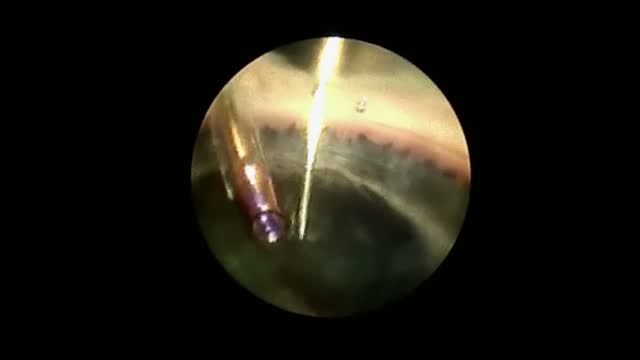 Cataract Surgery From the Inside Out: An Endoscopic View of Cataract Surgery