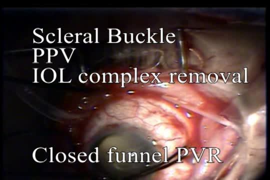 Bandage Lens Technique (BLT) for Corneal Clarity During Vitrectomy 