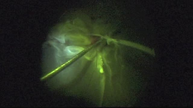 PhacoVitrectomy for Diabetic Tractional Retinal Detachment