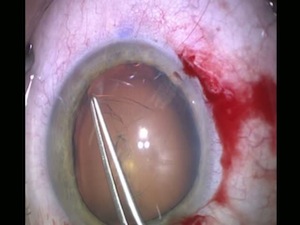 Malyugin and CTR in Marfan's Case
