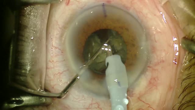 Victus Femtosecond Laser With Symfony IOL