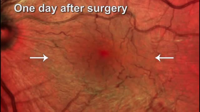 25G Vitrectomy for Macular Pucker