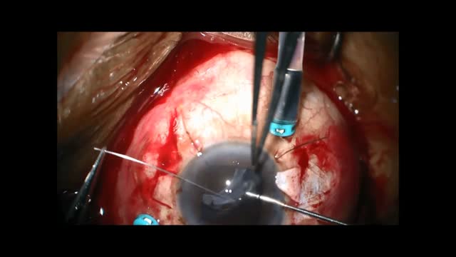 Scleral Fixation of Dislocated Acrylic IOL