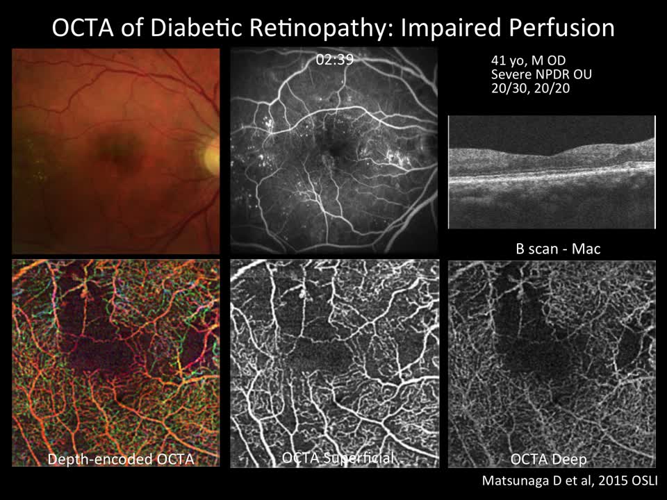Can we use OCT-A to detect early diabetic changes?