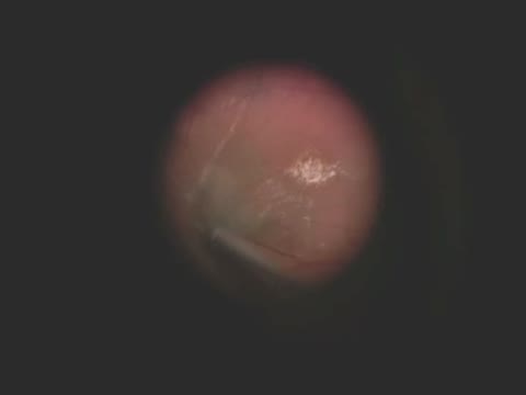 Phaco-Vitrectomy for Cataract with Psuedoexfoliation and Macular Hole
