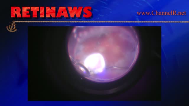 Chorioretinal Biopsy