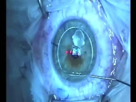 Advanced All Laser Z-LASIK Laser Eye Surgery