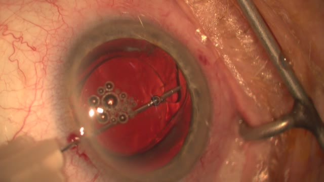 IOL Exchange After YAG Capsulotomy Five Years Out