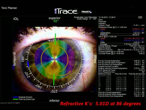 Laser Assisted Cataract Surgery with a Tecnis Toric Extended Range IOL & ORA Aberrometry