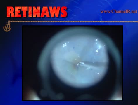 Diabetic Vitrectomy