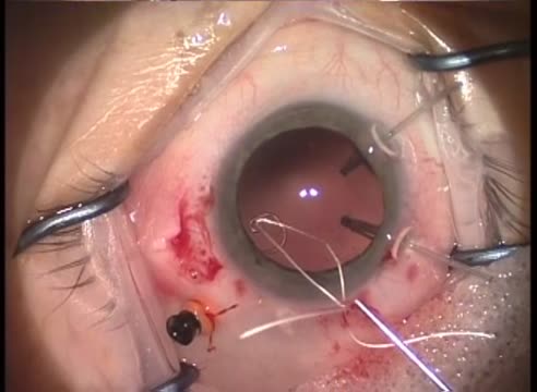 PPV, Modified CTR, CTS, and Cerclage