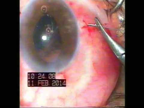 In situ Bag Repositioning with Double Haptic Scleral Fixation of Multi-piece IOL