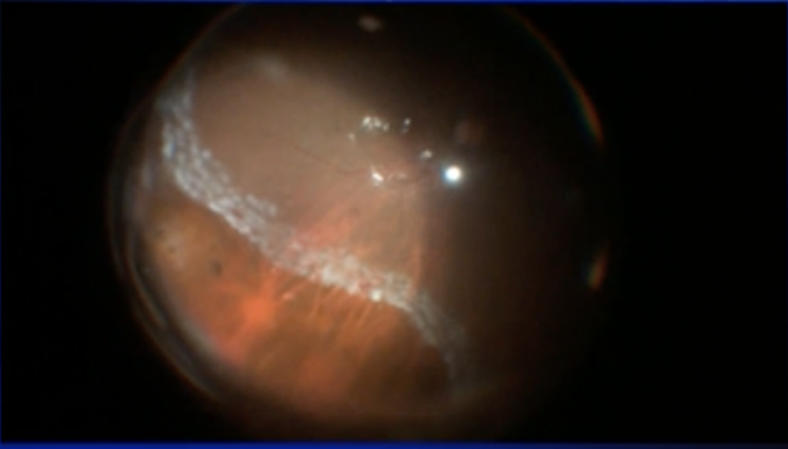 Supra-Choroidal Buckling for Large Breaks