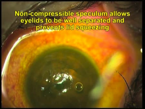 Contact Lens Assisted Collagen Crosslinking (CACXL)