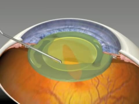 Capturing a Rotating Toric IOL