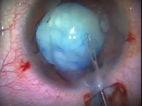 Extremely Fibrotic Capsule