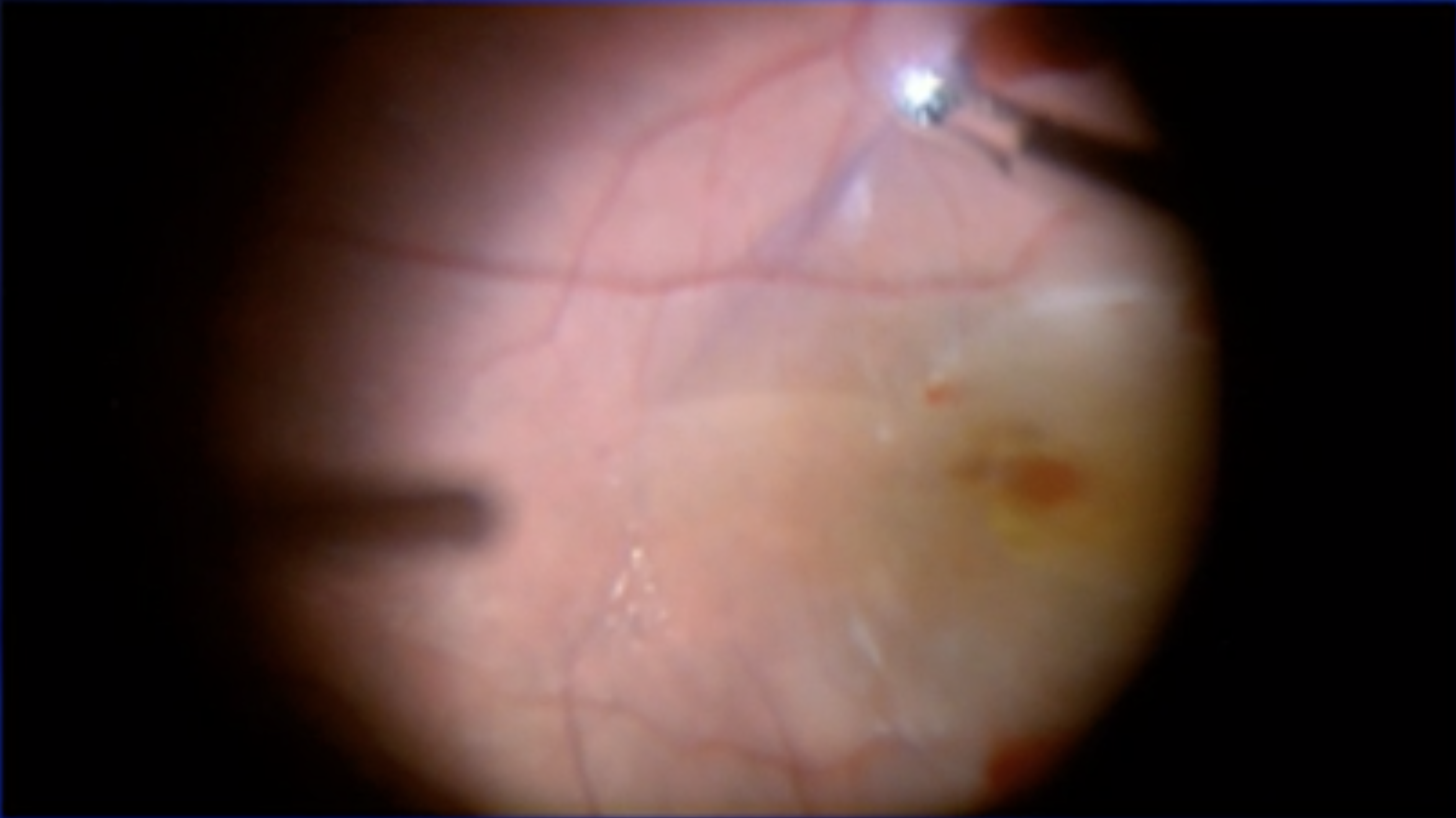 ILM Peeling & Bleeding