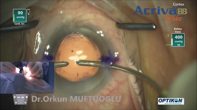 How to Implant the Acriva Toric