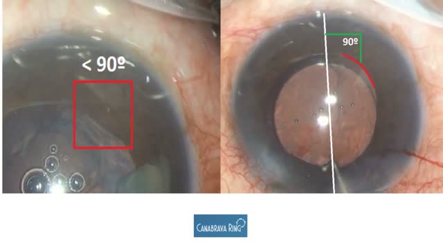 Capsular Tension Ring: Everything You Should Know - Eyetube