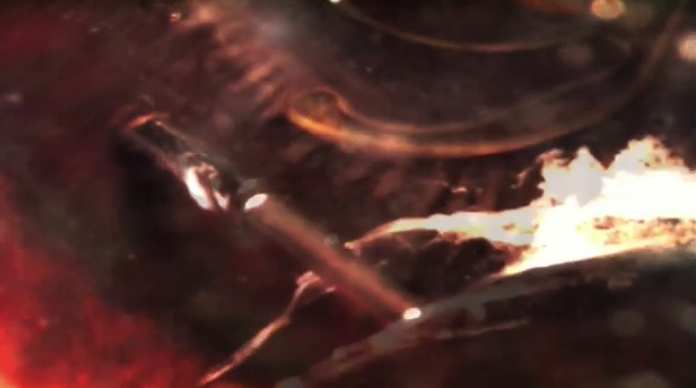 Vitreous Dynamics- Types of Vitreous Traction