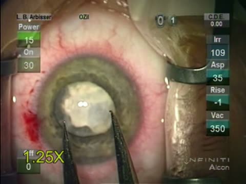 Post Traumatic Leukocoria