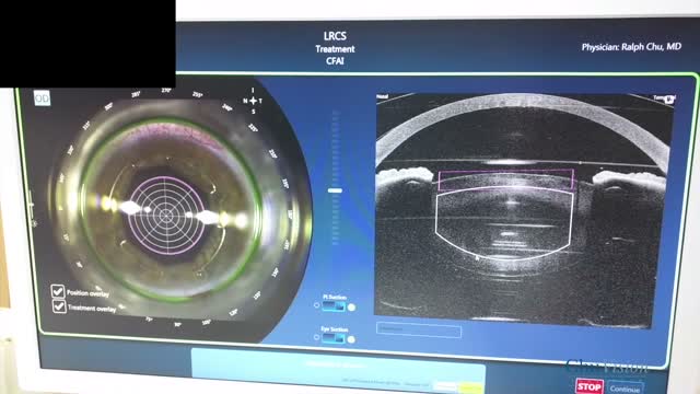 Use of the Xpand Pupil Expansion Device With Victus Laser Cataract and Crystalens