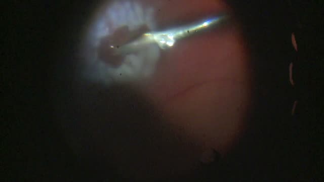 Repair of Rhegmatogenous Retinal Detachment Associated With Retinoschisis 