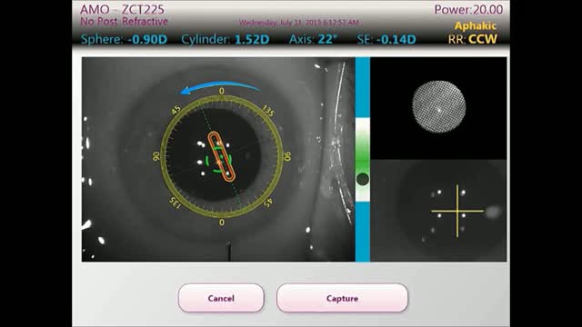 Cataract Surgery and ORA Intraoperative Aberrometry in a Post-LASIK Case