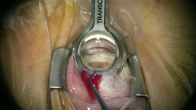 Intraoperative Gonioscopy