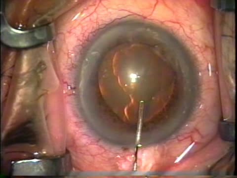 Preventing Iris Prolapse From Posterior Pressure - Eyetube
