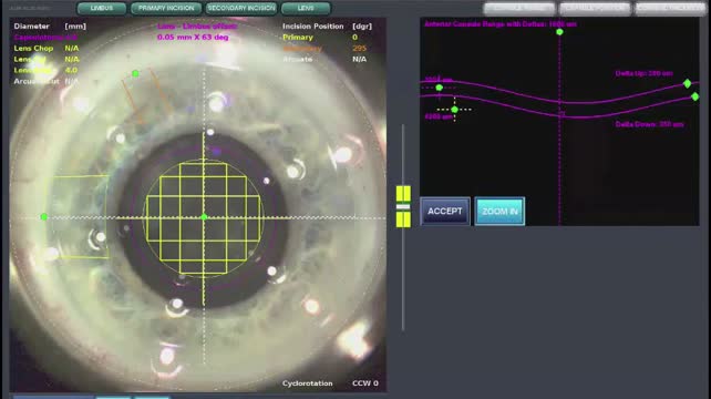 Laser Cataract Surgery With Implantation of the Trulign Toric IOL