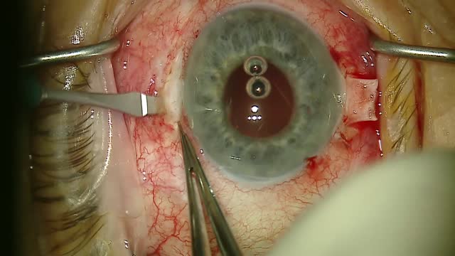Complication: When a Simple Glued IOL Turns Into IOL Exchange