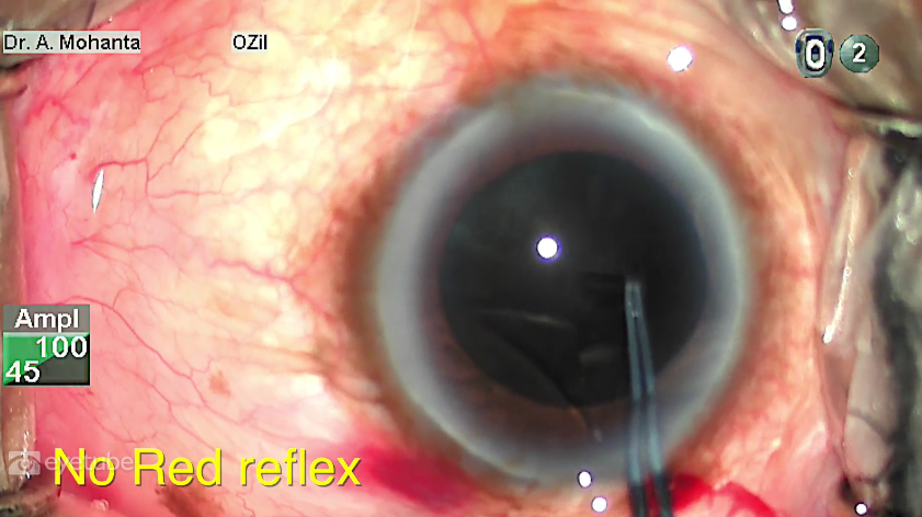 Pearls for Managing Brunescent Cataracts