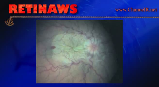 Hypotony Post Cataract Surgery