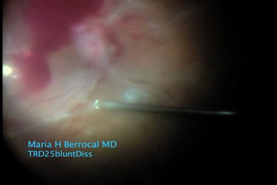 Tractional Retinal Detachment Blunt Dissection 