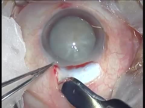 Mature cataract SICS