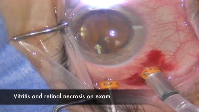 Retinal Detachment in Acute Retinal Necrosis