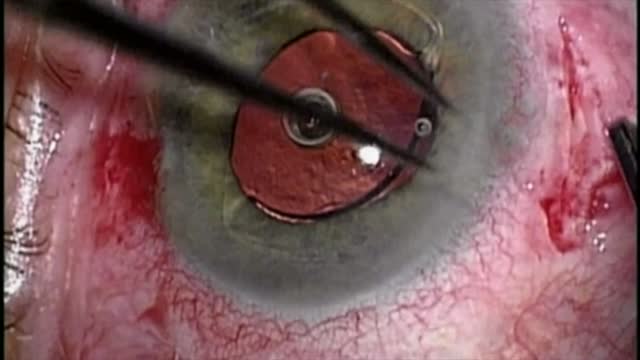 Dislocated ACIOL Explantation to Intrascleral Fixated IOL