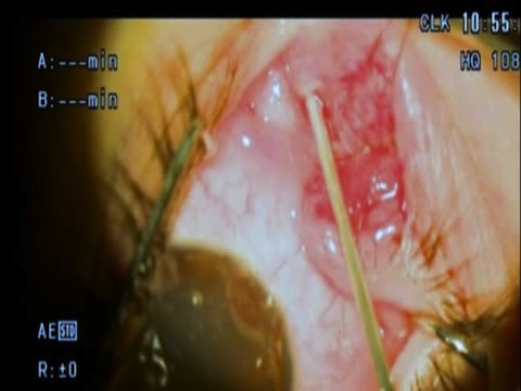 Canalicular Laceration