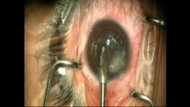 Pupilloplasty Post Traumatic Cataract by Seiper's Sliding Knot and Fugo Blade