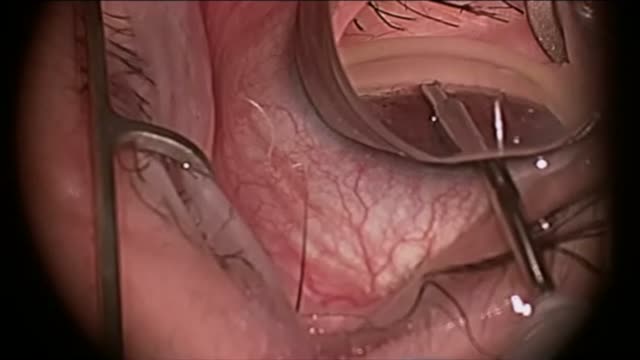 Pigmentary Glaucoma Trabectome Stand Alone