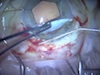 Forceps for IMT Implantation