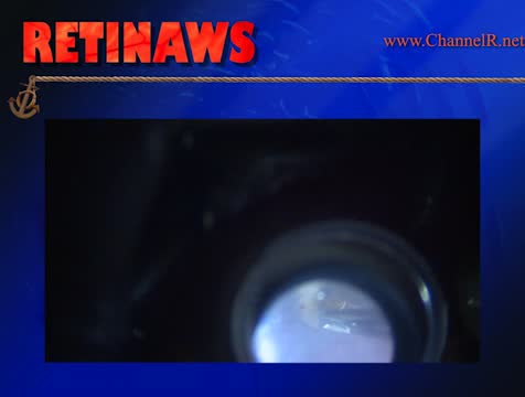 Optic Nerve Pit