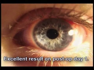Use of Triamcinolone in Challenging Anterior Segment Surgery
