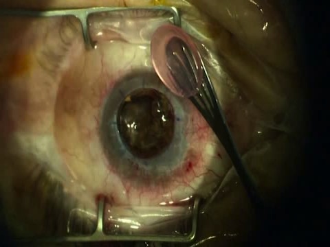 Complex Corneal Transplantation, Cataract Surgery, Synechialysis