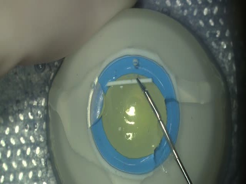 No-touch Technique for Removal of a Dexamethasone Implant