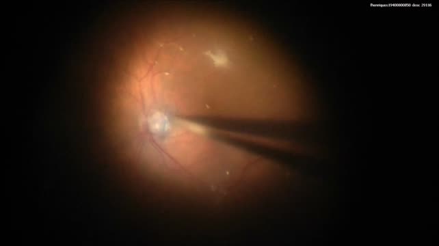 Optic Disc Pit Maculopathy: Surgical Approach with Flap Over the Optic