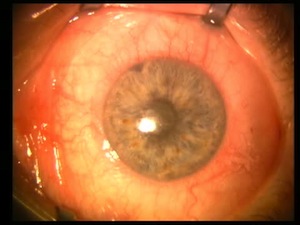 Placement of Iris Hooks